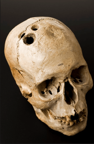 Trepanation ist die uralte Praxis, ein Loch in den Schädel zu bohren. Es ist eines der ältesten medizinischen Verfahren der Menschheit.