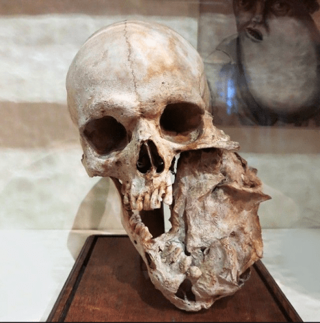 Schädel mit Unterkiefertumor im Bleuland-Kabinett im Universitätsmuseum Utrecht, Niederlande