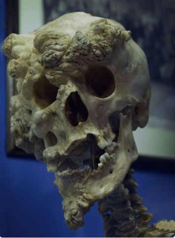 هذه هي جمجمة جوزيف ميريك ، والمعروفة أيضًا باسم The Elephant Man.