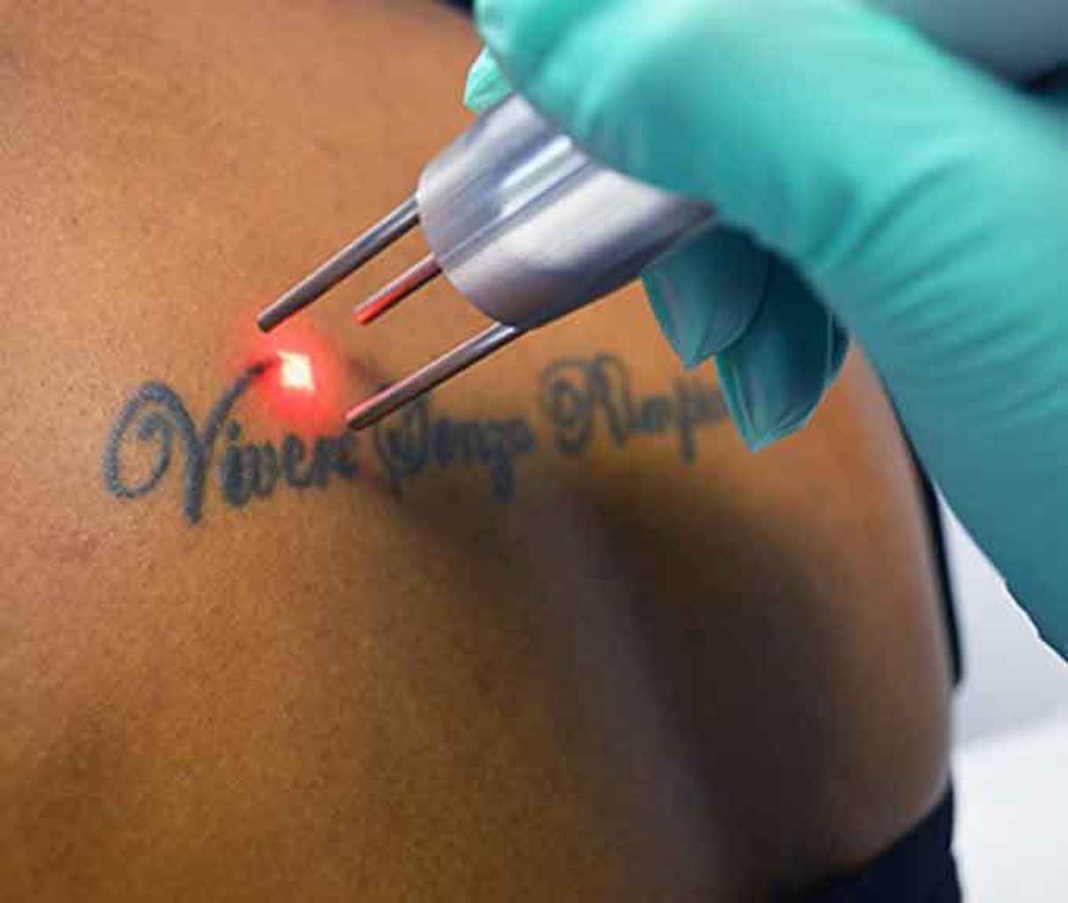 nejlepší laserový stroj na odstranění tetování