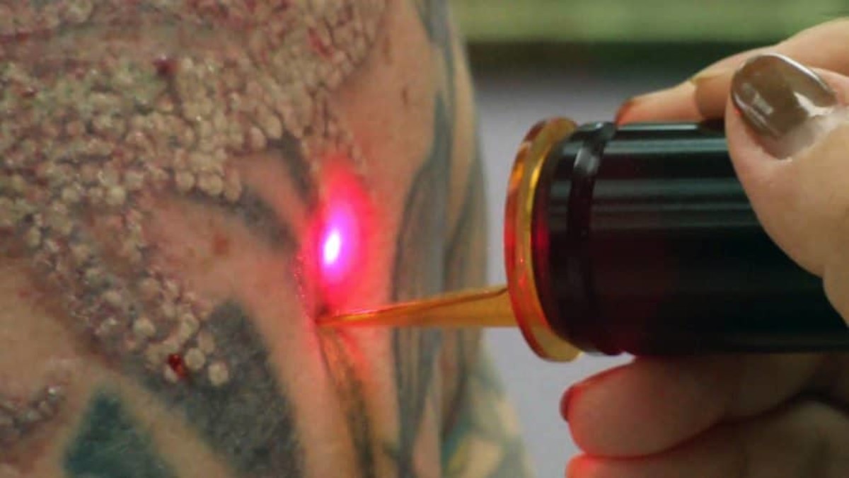 Laser-Tattoo-Entfernung