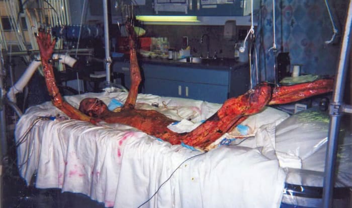 Foto via iflscienceAm 30. September 1999 war Hiroshi Ouchi gerade 35 Jahre alt. Ouchi und zwei Mitarbeiter lagerten Uranylnitrat mit einem Wert von 16 Kilogramm Uranionen in einen Niederschlagstank ein, als sich ein Unfall ereignete, bei dem Ouchi 20.000 Mal der maximal tolerierbaren Menge an Neutronenstrahlung ausgesetzt wurde. Das Ergebnis war katastrophal für seinen Körper, da starke Strahlung aus Neutronenstrahlen durch seinen Körper riss und seine DNA in Stücke riss. Das herzlose und egoistische Ärzteteam, das an Ouchi arbeitete, hielt den armen Mann 83 Tage lang am Leben. Die Liste der schrecklichen Dinge, die mit seinem Körper passiert sind, ist betäubend. Seine letzten Worte waren: 