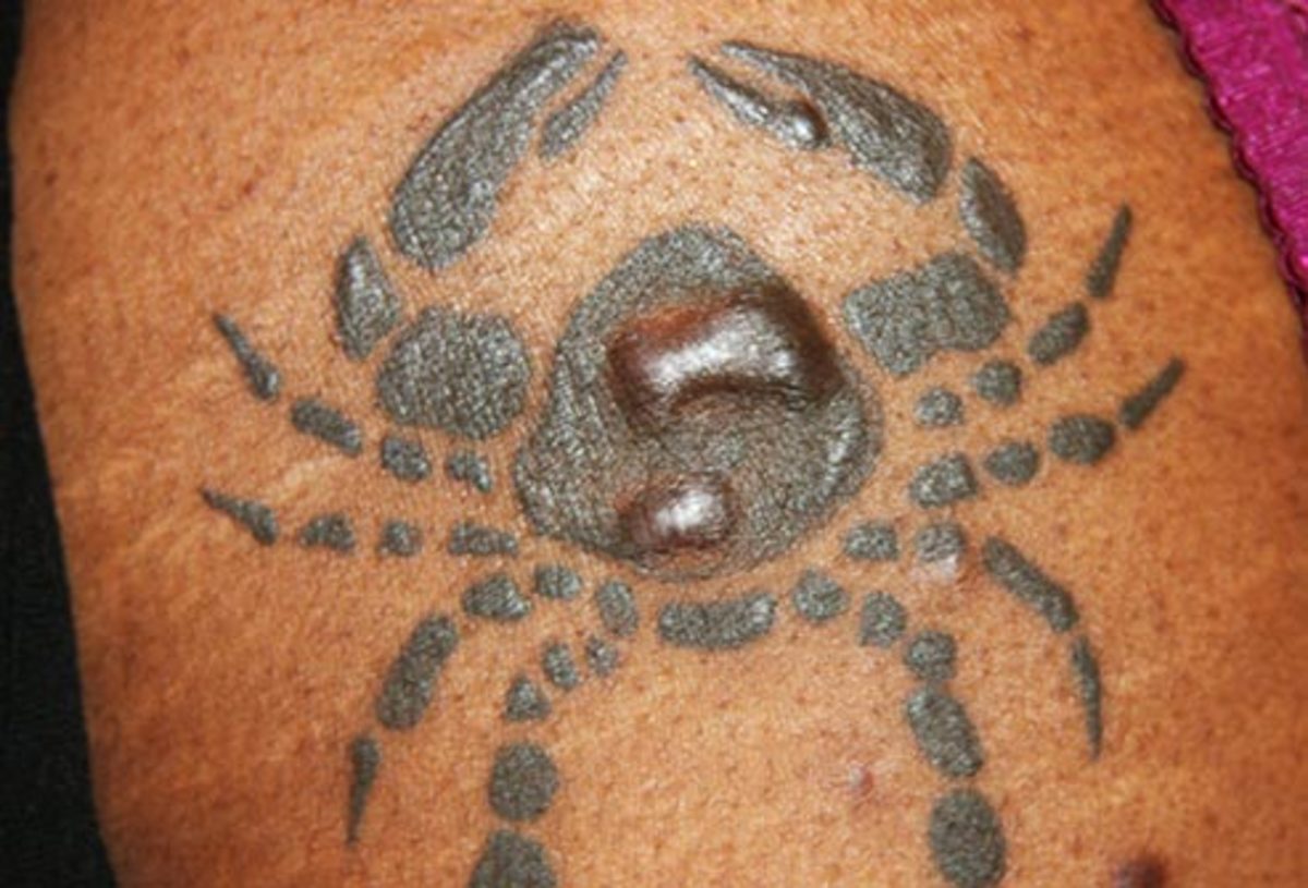 tattoo-cause-keloid-of-tattoo-problems-slideshow-when-tattoos-get -infikovaná