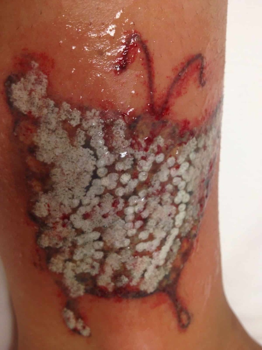 Infikované tetování s bílými skvrnami a vyrážkou