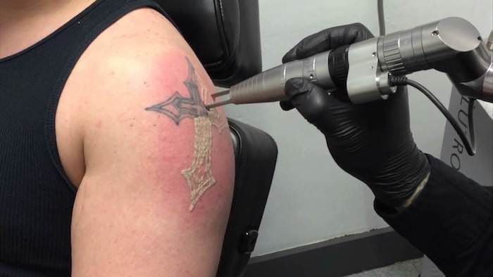 In erster Linie sind Tätowierungen nicht dauerhaft, weil wir die Technologie und die Mittel haben, um sie zu entfernen. 2018 kannst du dein Tattoo komplett mit einem Laser entfernen. Oder, wenn Sie sich rebellisch fühlen, können Sie es mit einem Skalpell ausschneiden, mit Säure verbrennen oder es auf andere Weise aus Ihrem Körper entfernen. Nicht, dass wir die zuletzt genannten Methoden empfehlen, aber sie sind mögliche Optionen.