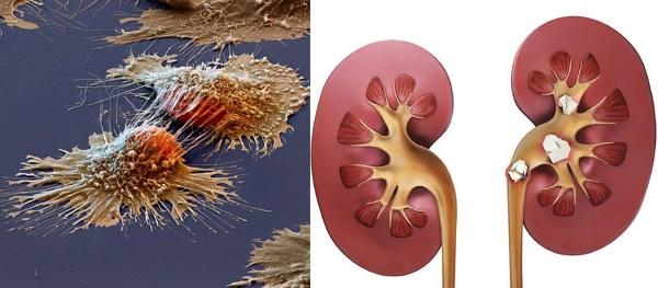 l'argousier au miel va vaincre les cellules cancéreuses et la lithiase urinaire