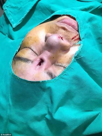 Fotografie přes dailymail Obrázky ukazují, že ženě v nose zůstal kráter, kde býval silikonový implantát, a není jisté, jak chirurgové plánují opravit její zpackanou rhinoplastiku, která jí zanechala díru v čele.