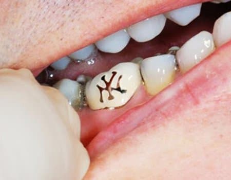 تأتي الصور عبر GoogleTooth Tattoos مع بعض السلبيات. وفقًا لـ dentoxpert ، تتراكم اللويحات حول الوشم والتي يمكن أن تسبب تسوس الأسنان.