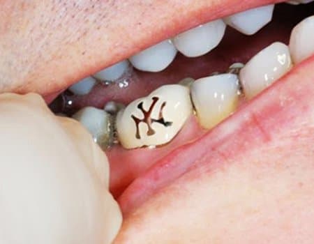 Foto über GoogleTooth Tattoos haben einige Nachteile. Wie zum Beispiel Plaque, die sich um das Tattoo herum ansammelt, die laut dentoxpert Karies verursachen kann.