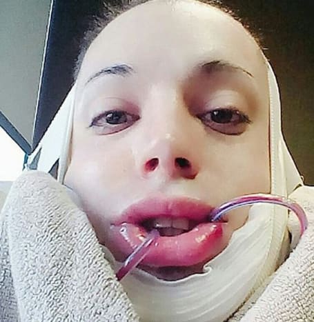 صورة عبر @ luispadron.elfPadron سافر مؤخرًا إلى كوريا الجنوبية لإجراء جراحة الفك على شكل حرف V. 
