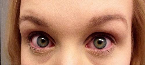 La rougeur des yeux est l'un des symptômes des allergies