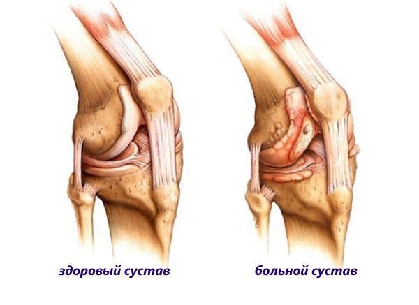 con enfermedad articular