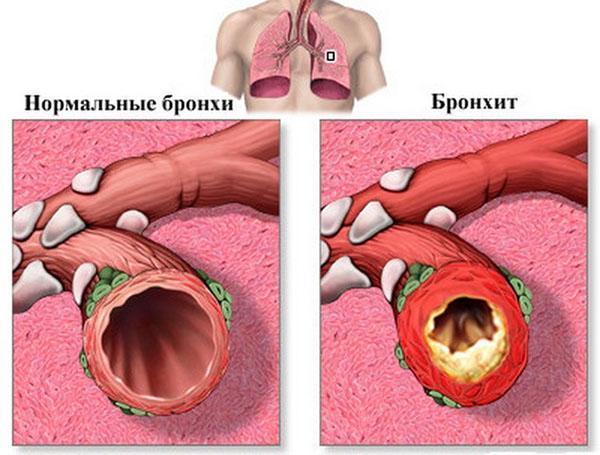 para el tratamiento de la bronquitis