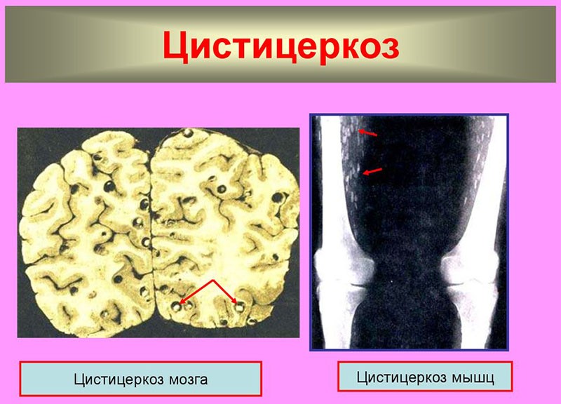 dommages aux organes par la cysticercose