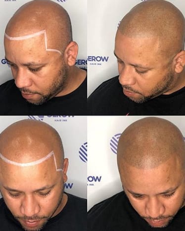 Image via @jonathangerowBemerkenswerte Ergebnisse mit einem natürlichen Ergebnis. Nicht nur Männer kommen zu Gerow zur Haarausfallbehandlung, sondern auch Frauen suchen seine Dienste. Am besten erreichen Sie ihn über seine Website.