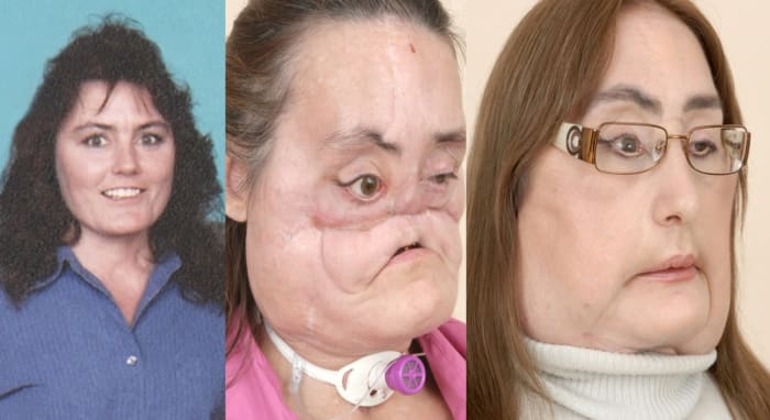 Foto přes Clevelandclinic Během útoku utrpěla Connie Culp výstřel z brokovnice do obličeje. Naštěstí přežila, ale bude potřebovat rozsáhlou operaci obličeje, která byla provedena na Clevelandské klinice. Jednalo se o první téměř úplnou transplantaci obličeje provedenou ve Spojených státech.