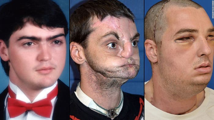 Foto přes cnnRichard byl pohledný mladý muž, když se bohužel zapojil do nehody se zbraní, která mu sfoukla značnou část spodní části obličeje. Než podstoupil transplantaci obličeje, 15 let nosil chirurgickou masku, která zakrývala jeho znetvořený obličej.