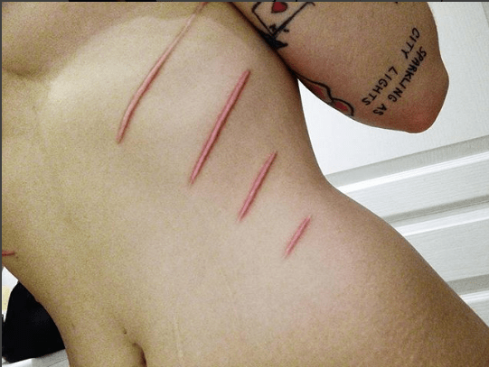 Foto von Alderaans InstagramDiese Narbenbildung verheilte sehr gut und hinterließ eine Erleichterung auf ihrem Körper.
