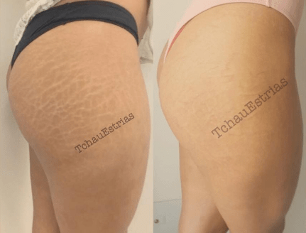 Schließlich können Sie nicht nur große Pigmentanomalien korrigieren, sondern auch im Mikromaßstab – indem Sie Dehnungsstreifen mit Tattoo-Pigment abdecken!