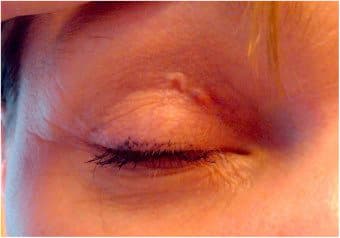 وفقًا لمجلة نيو إنجلاند الطبية ، أبلغت المرأة البالغة من العمر 32 عامًا عن ظهور نتوءات غريبة أسفل عينها اليسرى انتقلت لاحقًا فوق عينها ثم نزولًا إلى شفتها العليا.