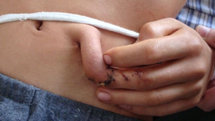 Foto via pinterestWang Yongjun, 20, war Möbelarbeiter in der Provinz Liaoning, als er sich mit einer elektrischen Säge das Ende seines Mittelfingers abtrennte. Wang wurde ins Krankenhaus eingeliefert, wo schnell denkende Ärzte sahen, dass Muskeln und Haut weggeschnitten worden waren und nur noch Knochen übrig blieben. Die Ärzte operierten und befestigten Wangs Finger an seinem Bauch, in der Hoffnung, dass dies eine Möglichkeit wäre, die Durchblutung des verletzten Fingers wiederherzustellen, damit sich der Körper mit neuer Haut reparieren und Muskeln um den exponierten Bereich herum wachsen können.