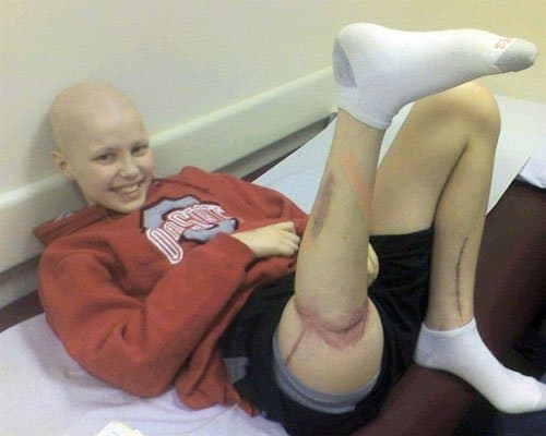 تم تشخيص دوجان سميث ، البالغ من العمر 13 عامًا ، بسرطان العظام واضطر للخضوع لعملية جراحية لبتر جزء من ساقه من الفخذ إلى الركبة. قرر دوغان إجراء عملية 