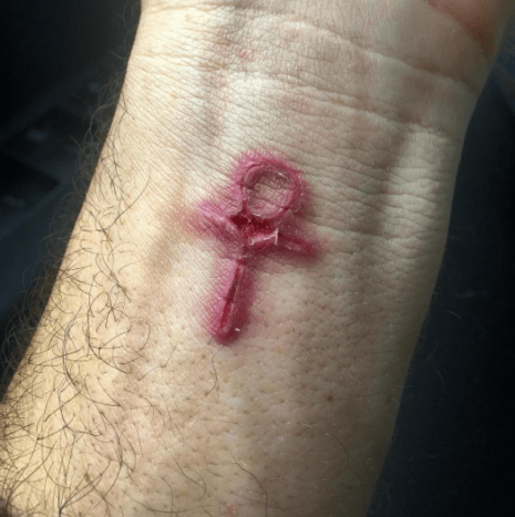 infiziertes Ankh Tattoo am Handgelenk