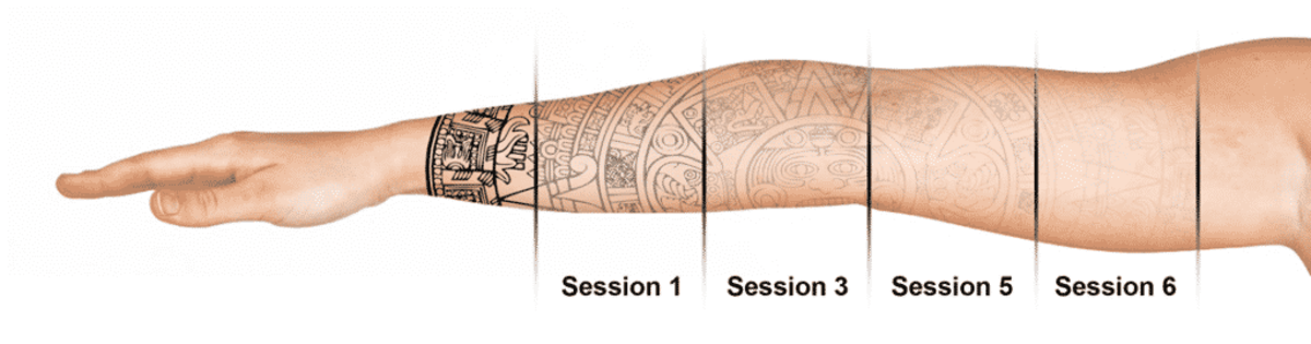 West-Seattle-laser-tetování-odstranění-Well-Medical-Arts-1024x269