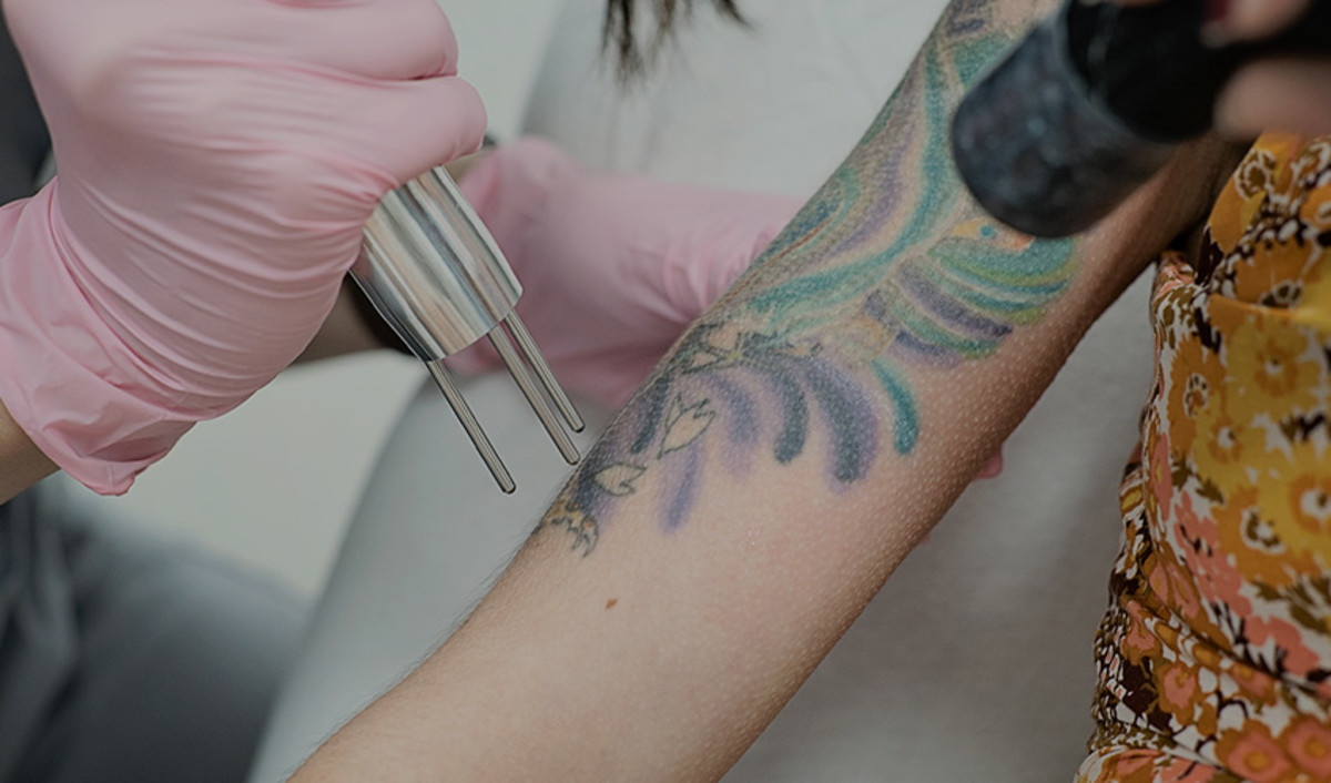 umístění-hrdina-laser-tetování-odstranění-mobilní