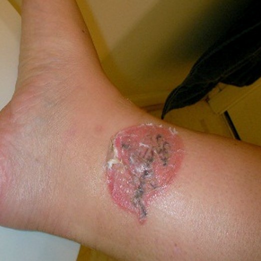 Jak identifikovat a opravit infikované tetování