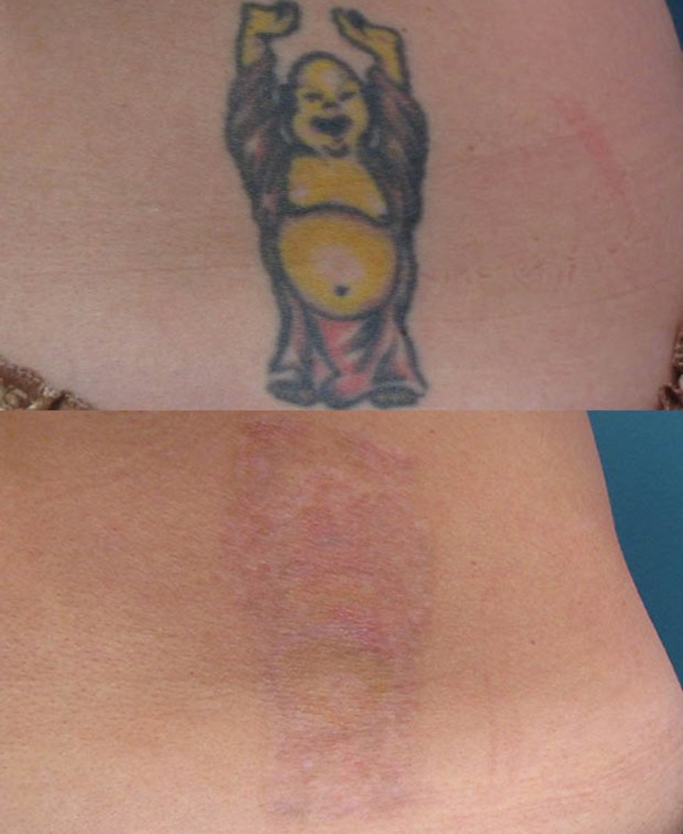 enlighten_tattoo_removal_comparison1