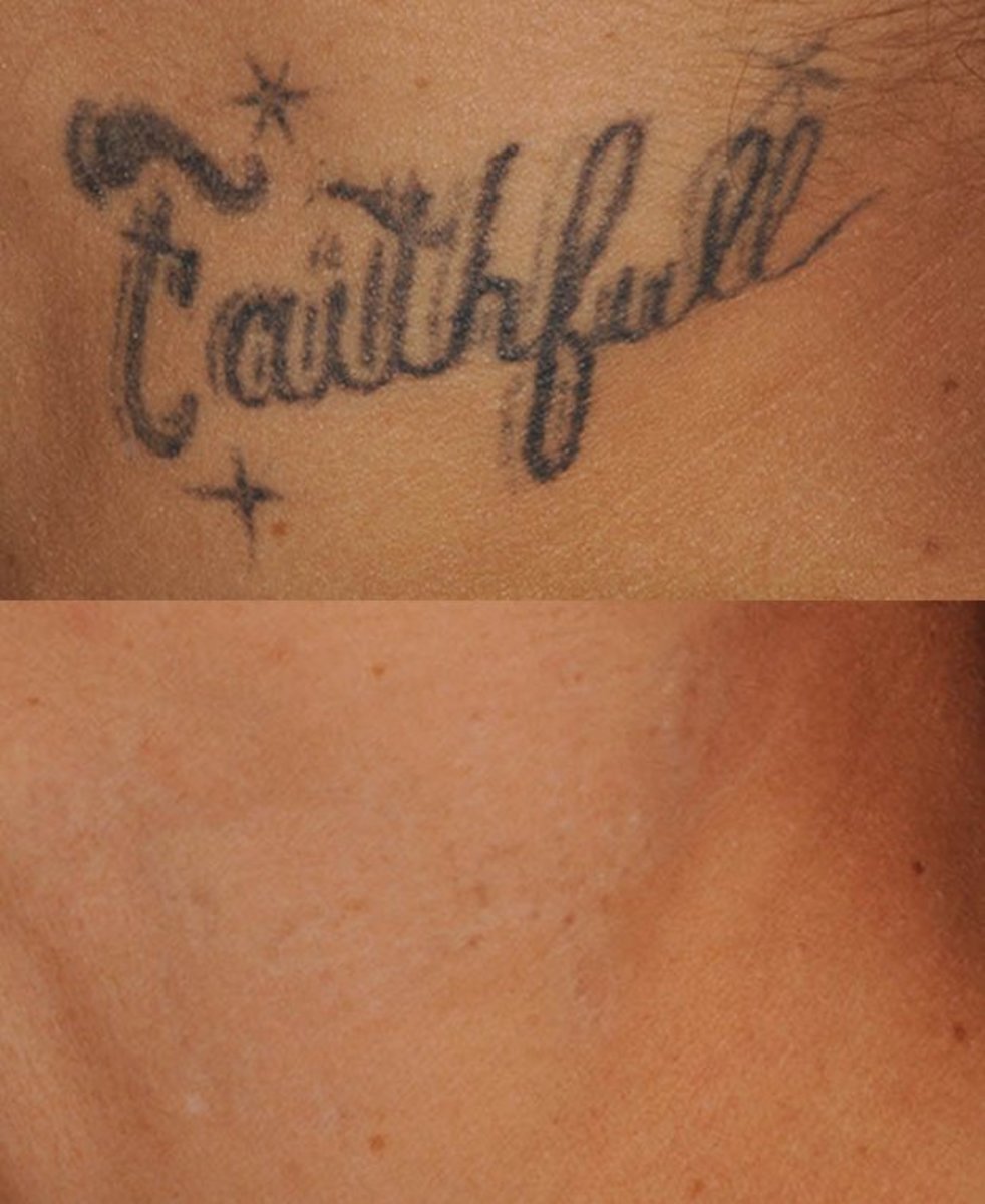 erleuchten_tattoo_removal_comparison3