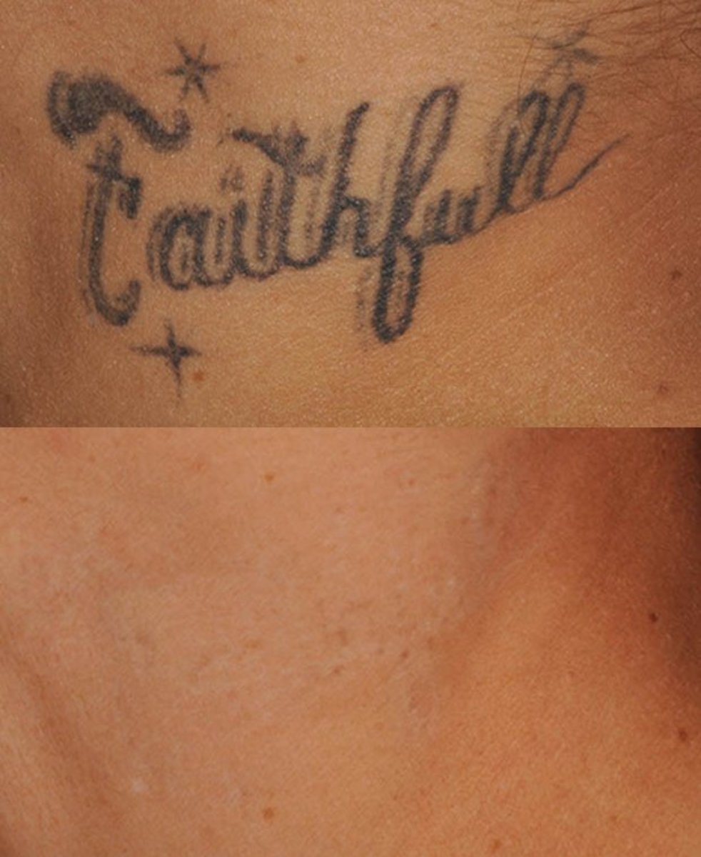 enlighten_tattoo_removal_comparison3