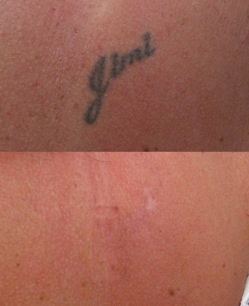 erleuchten_tattoo_removal_comparison2