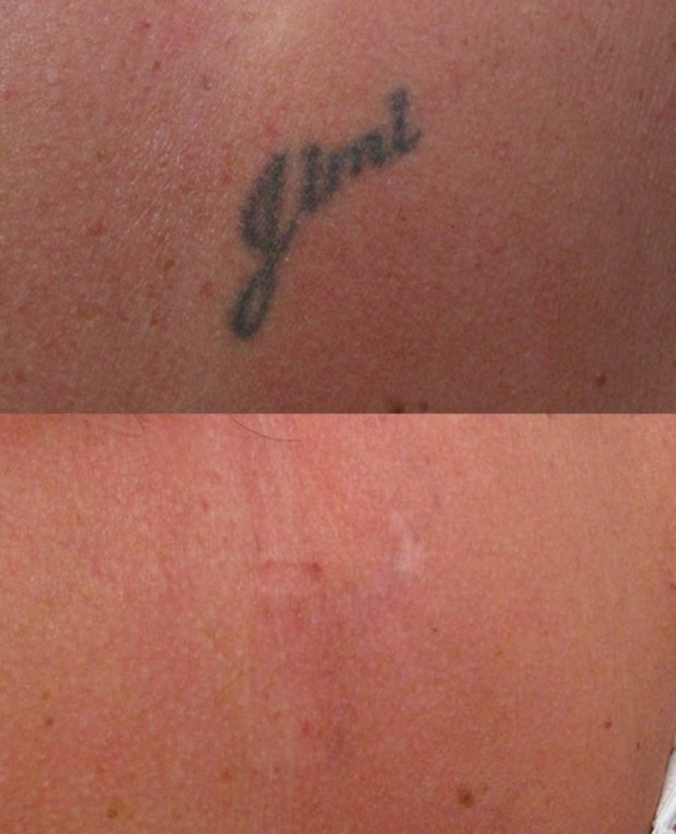 enlighten_tattoo_removal_comparison2