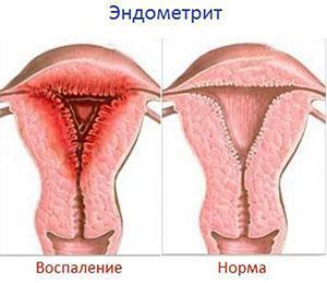 Diagnóstico de endometritis
