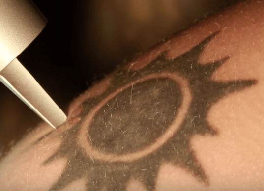 chlap, který si nechal laserovat tetování na slunci