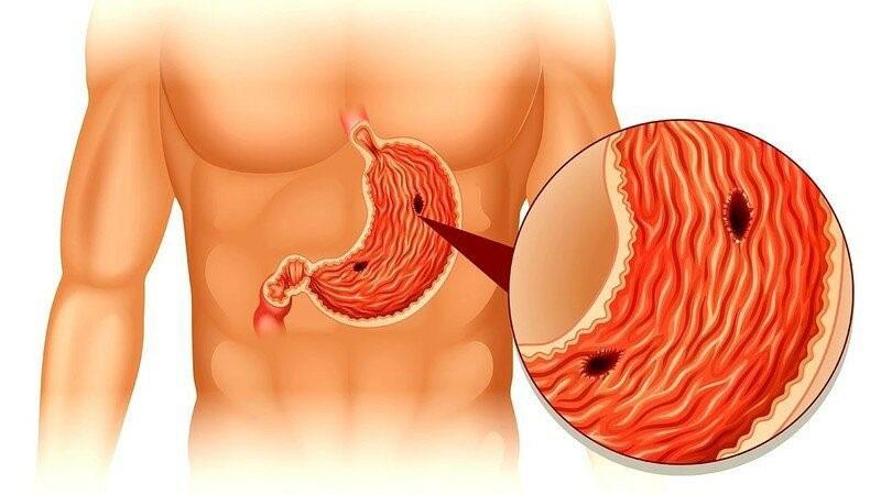 úlcera estomacal