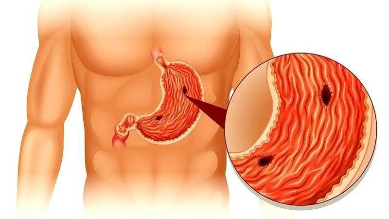 ulcère de l'estomac