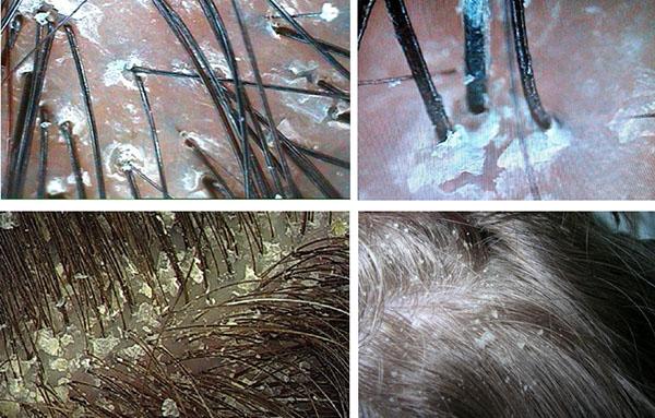 moutarde pour lutter contre les pellicules