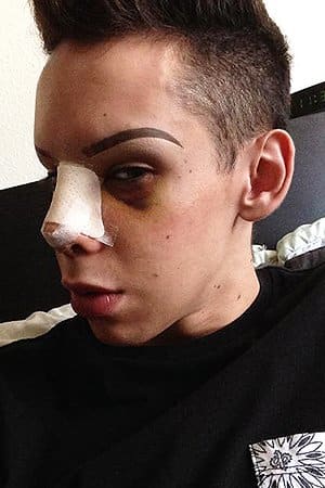 Foto über Barcroft MediaVinny hat über 100 Eingriffe durchgeführt, darunter zwei Nasenkorrekturen sowie Wangen- und Knochenfüller, wie in seinem Kiefer und seinen Brauen. Laut The Sun hat er drei Operationen und 35 Körper- und Gesichtslaserbehandlungen hinter sich.