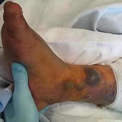 Foto via BMJ CASEAIn der Notaufnahme begannen sich die Läsionen zu verändern. Sie gingen schnell von flachen violetten Läsionen mit schwarzen Rändern zu schmerzhaften, mit Flüssigkeit gefüllten Blasen (medizinisch als Bullae bezeichnet). Nach Angaben der Ärzte in den BMJ-Fallberichten begannen diese Blasen in alarmierender Geschwindigkeit anstelle der Läsionen auszubrechen.