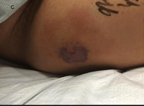 Foto via BMJ CASE Als die Laborarbeit zurückkam, zeigte sie hohe Leberenzymwerte, was auf eine chronische Lebererkrankung in der Vorgeschichte hindeutete und dies wurde vom Patienten bestätigt. Die Situation wurde sehr ernst und die Ärzte mussten eine Diagnose stellen. Sie kamen zu dem Schluss, dass das Fortschreiten der Läsionen – zusammen mit den beeinträchtigten Leberfunktionen des Mannes und der neu entdeckten Information, dass der Patient kürzlich mit der offenen Wunde der Tätowierung im Golf schwimmen ging – wahrscheinlich mit dem im Meer übertragenen Bakterium Vibrio vulnificus infiziert war .