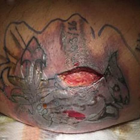 Foto über BMJ CASESUnmittelbar nach dem Tod des Mannes, sahen die Ärzte eine Kombination aus Lebererkrankungen, Nierenversagen und nekrotischen Hautläsionen (Fleischfresserkrankheit), die durch die Einführung von Vibrio vulnificus durch sein Tattoo beim Schwimmen im Golf von verursacht wurden Mexiko. Fünf Tage nachdem der Mann das Tattoo bekommen hatte, beschloss er, im Golf von Mexiko schwimmen zu gehen. Das erwies sich als fataler Fehler.