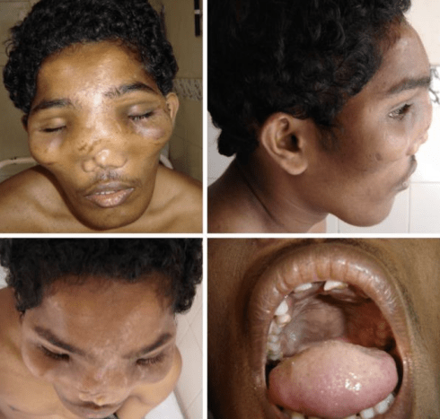 رجل مصاب بداء Leontiasis Ossea شذوذ طبي