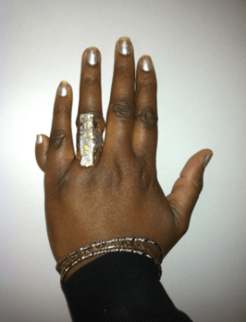 Frauenhand mit sechs Fingern