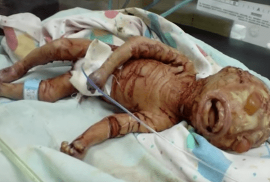 Baby ohne Haut geboren