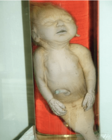 Meerjungfrauenbaby mit Beinen zusammen geboren