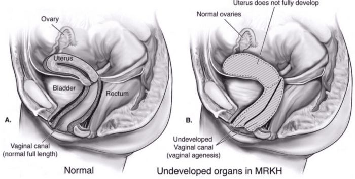 هناك العديد من الاختلافات في MRKH ، حيث تكون الأعضاء التناسلية إما متخلفة أو غائبة تمامًا. ومع ذلك ، فإن نمو الأعضاء التناسلية الخارجية والثدي طبيعي عادة للنساء المصابات بالـ MRKH.