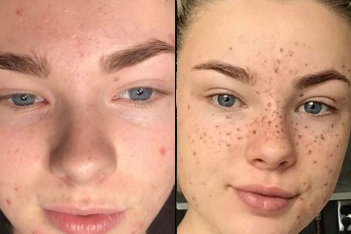 Schönheitschirurgie, kosmetische Tätowierungen, Microblade-Tattoos, Microblading, Sommersprossen-Tattoos, Augenbrauen-Tattoos